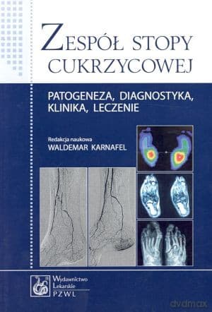Zespół stopy cukrzycowej. Patogeneza, diagnostyka, klinika, leczenie - Waldemar Karnafel (red.)